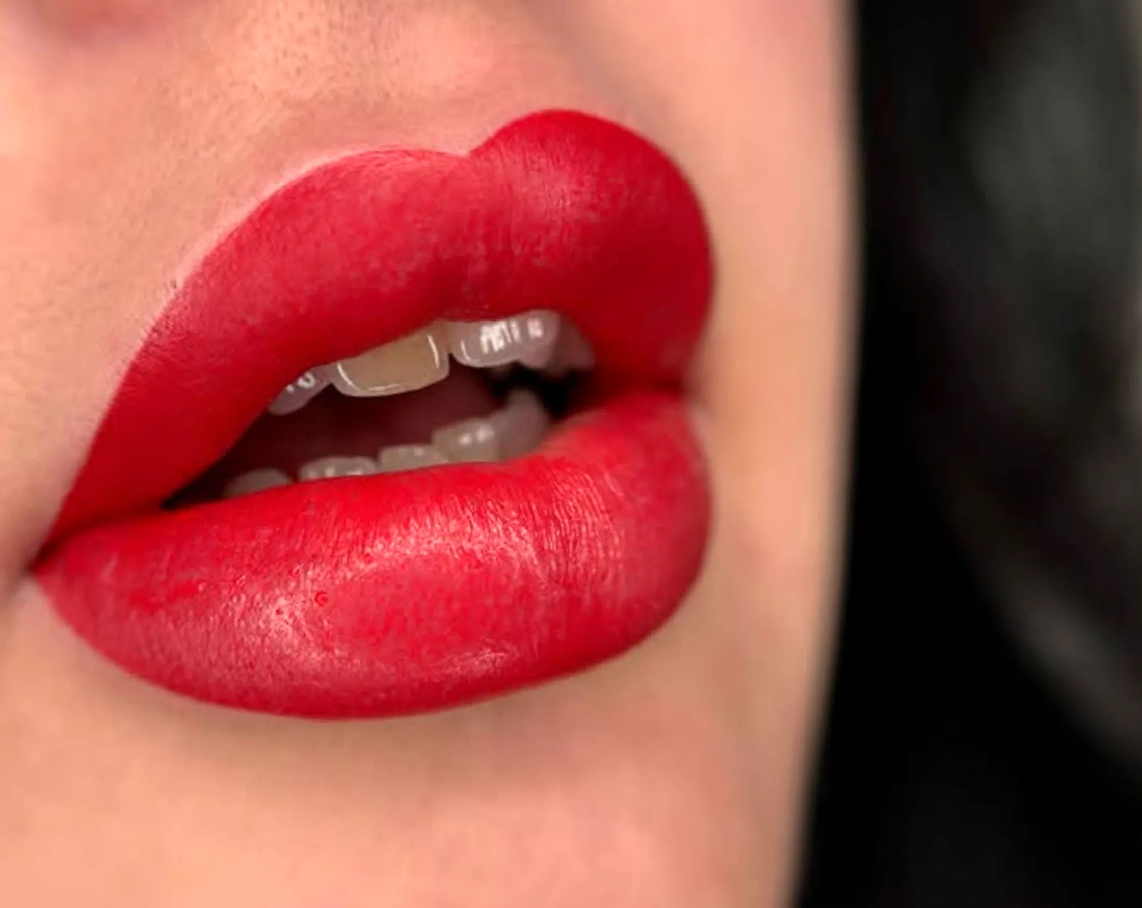 causes of dark lips