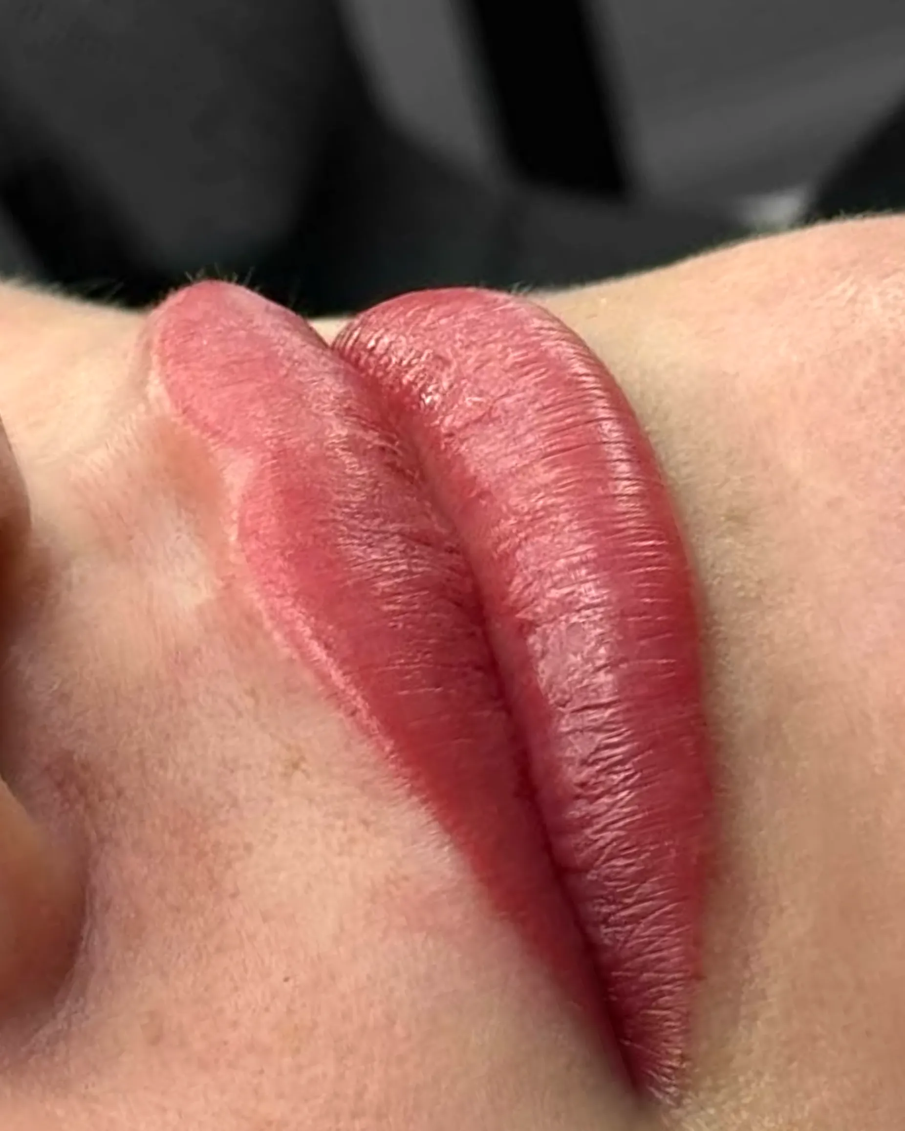 lip pigmentation treatments